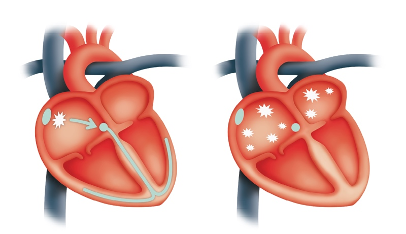 What Causes Paroxysmal Atrial Fibrillation?